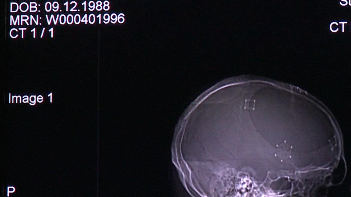 A X-ray of Chase Kear's skull after a ceramic plate was put in to replace the section of his skull that was removed in October of 2008. Kear underwent a craniotomy to remove swelling on his brain.