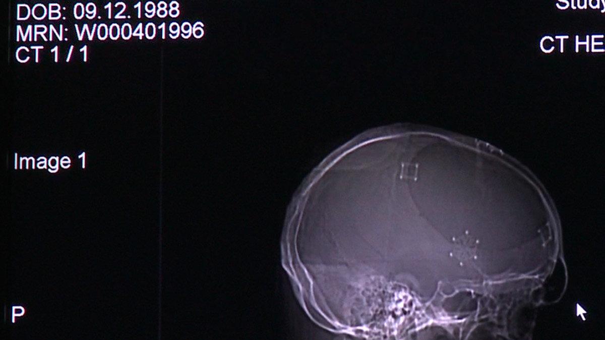 A X-ray of Chase Kear's skull after a ceramic plate was put in to replace the section of his skull that was removed in October of 2008. Kear underwent a craniotomy to remove swelling on his brain.
