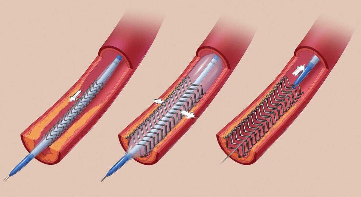 Stent: A metal mesh tube is implanted into a narrowed blood vessel to hold open its walls.