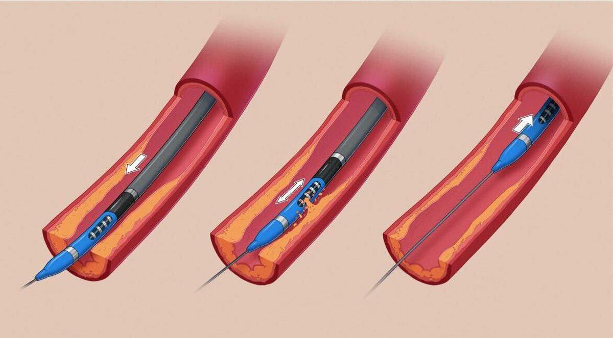Atherectomy: A catheter, often capped with a blade or laser, is inserted into a blood vessel and removes plaque off its walls.