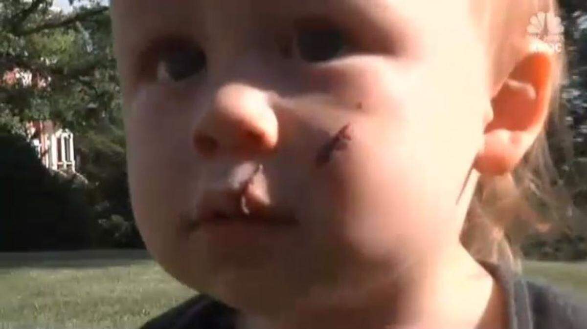 One-year-old Atticus needed five stitches in his face after he was hit by a drone at the park.
