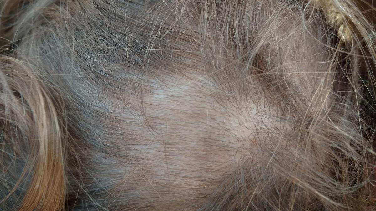 Brian Anderson says a patch of his daughter’s hair was taken during a random drug test at school.