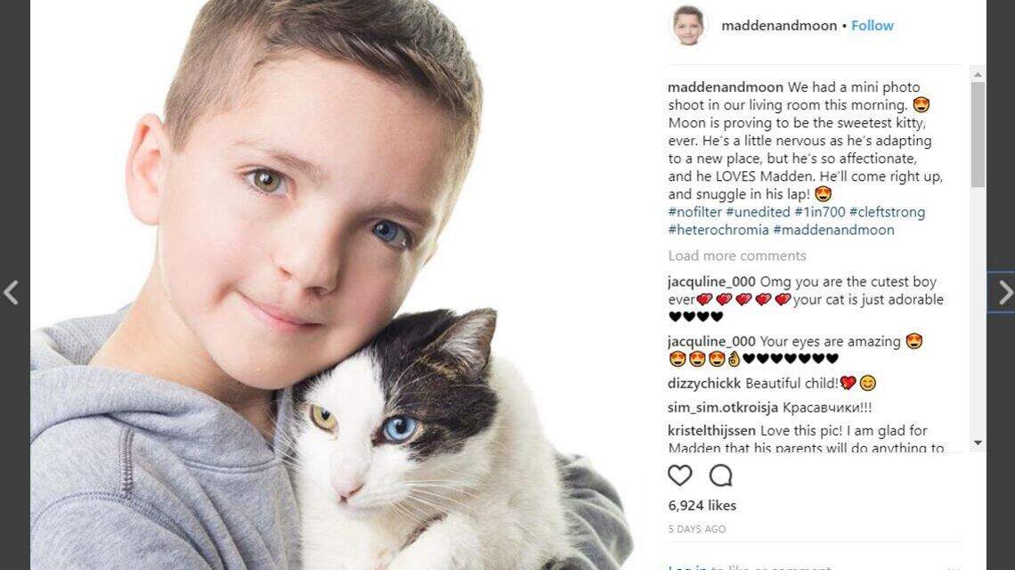 Bullied boy with different-colored eyes, cleft lip rescues cat with same rare conditions