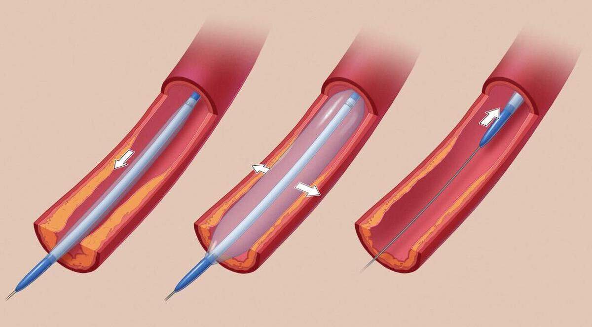 Angioplasty: A compact balloon is inserted into a blood vessel and inflated to flatten plaque against its walls.