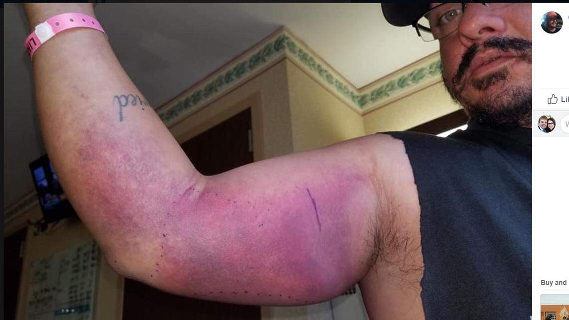 Grady Kornelson was swimming near Haven Lake at Cheney Lake when he felt a bite — then he saw a snake swimming toward his daughter and fiance. The bite, possibly caused by a copperhead snake, left a lot of swelling and bruises.