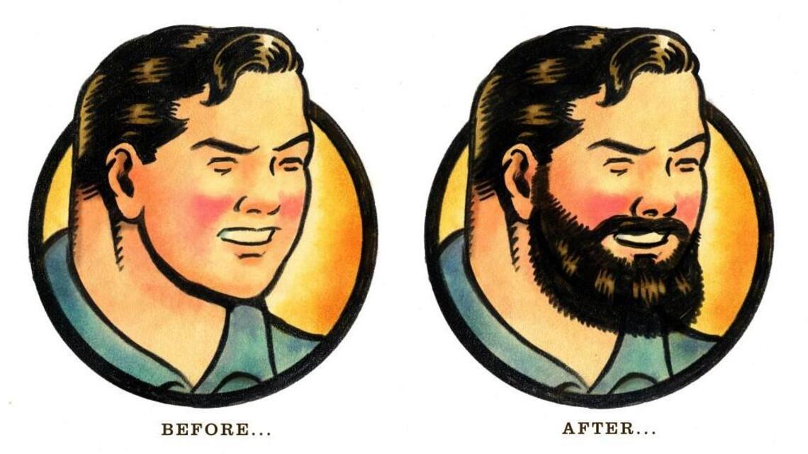 Beard transplants a growing option for baby-faced men