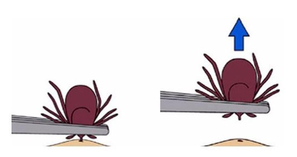 Use a tweezers to remove a tick. Pull straight up, slowly and gently.