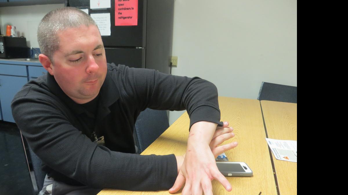 
Mail carrier Chad Lubrano shows the scars from an encounter with a pit bull on his route March 16. 
